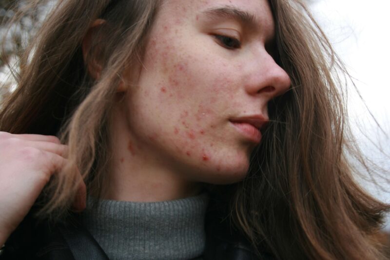 Clear Acne Naturally: 4 Secrets Your Skin Doctor Never Shared